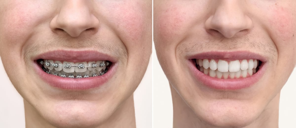 Two portraits of the same teenage boy with and without braces on his teeth, before and after comparison